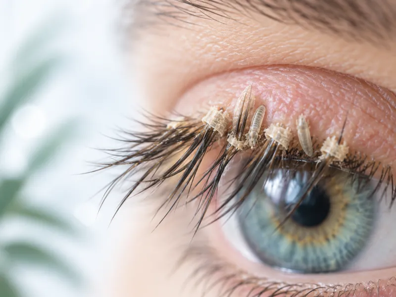 Collerettes à la base des cils et Démodex illustrés en gros plan