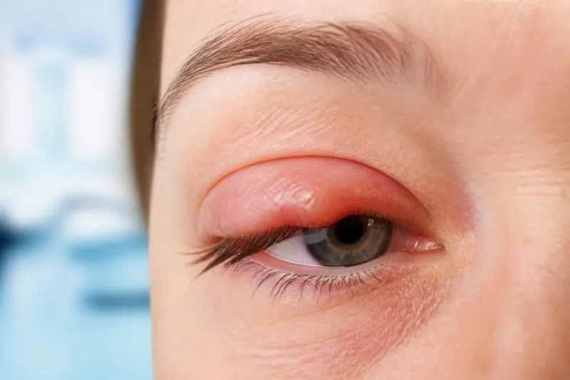 découvrez les causes courantes d'une paupière gonflée ou d'un chalazion, ainsi que les solutions efficaces pour soulager l'inconfort et favoriser la guérison.